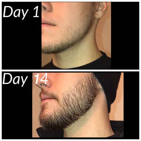Bạn sẽ nhanh chóng sở hữu bộ râu đầy nam tính chỉ sau hơn 2 tuần (*)